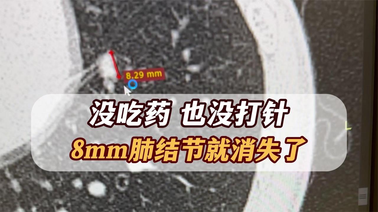 8mm肺结节消失了！没吃药也没治疗，靠的就是这个“法宝”