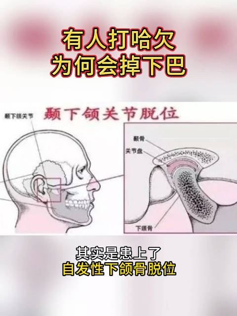 有的人打哈欠竟会掉下巴，其实是患上了自发性下颌骨脱位…