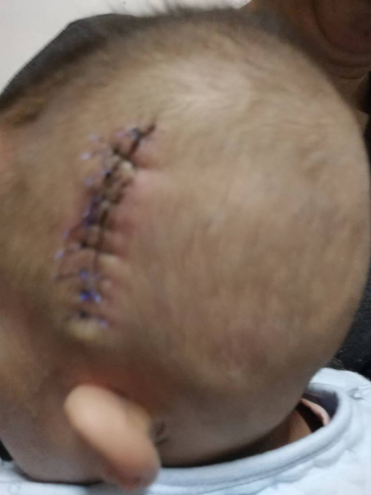 2018年12月30日，小白在西安市兒童醫院進行取出手術，手術失敗後在頭上留下的傷口。 受訪者供圖