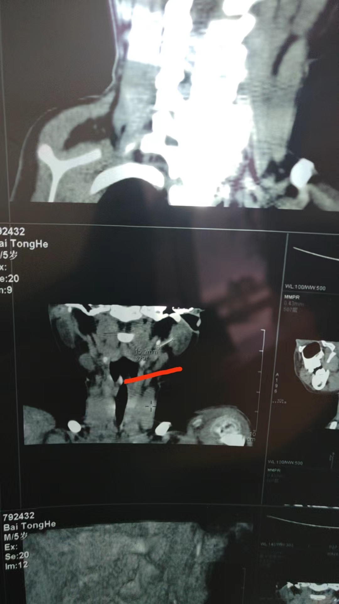 4月7日，星元醫院CT結果顯示，軟管目前位於小白頸部左側腮腺內。 受訪者供圖