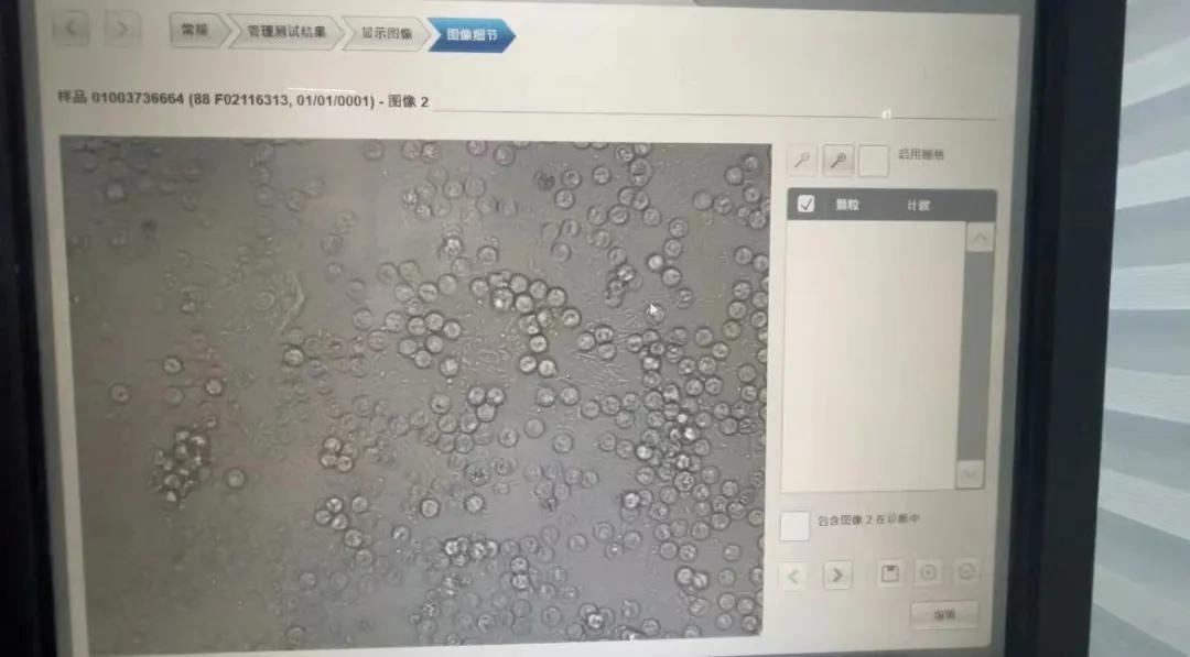 显微镜放大后的尿液标本