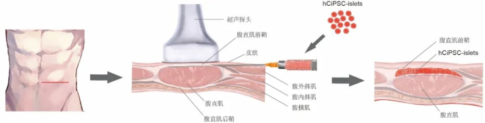 胰島細胞腹直肌前鞘下移植的示意圖。（受訪單位供圖）