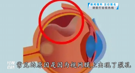 右眼变形什么原因,右眼变形什么原因引起的