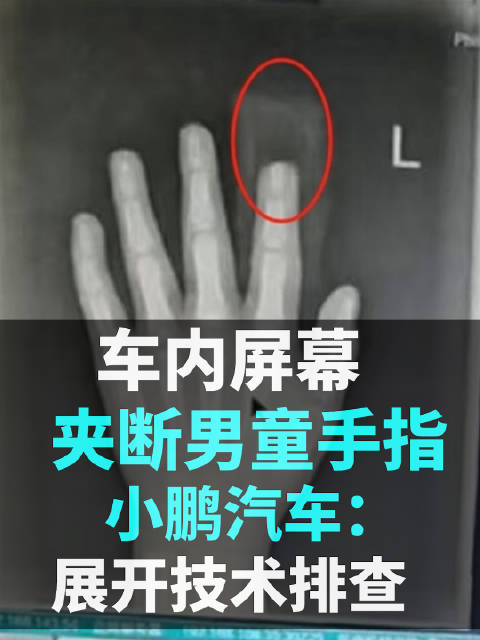 车内屏幕夹断男童手指，小鹏汽车：展开技术排查