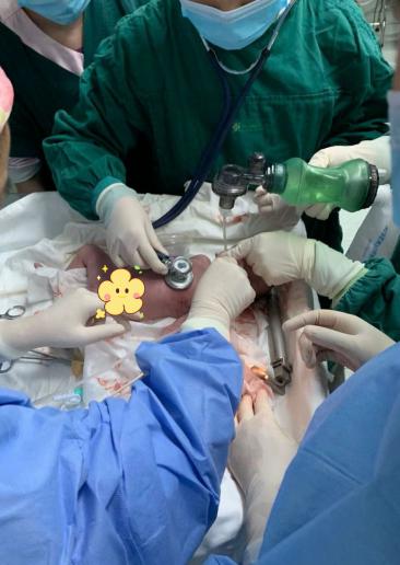 脐带扭转50 周！胎儿窒息命悬一线