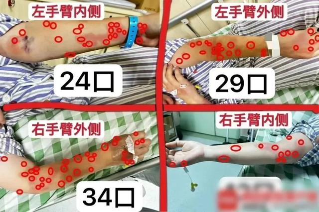 △4月5日,广西南宁梁女士在小区遭遇蜜蜂袭击,身上多处被蜇伤,随后被120急救车送往医院救治。(图源:中国消防)