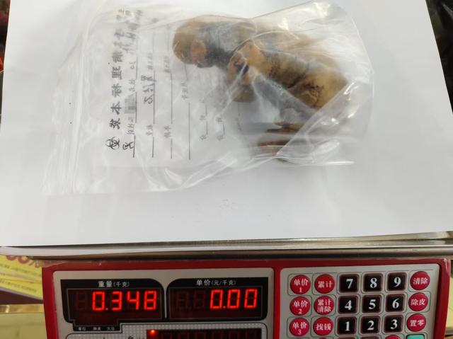 男子长期喝生水,肾脏竟长出巨大“姜块”结石!泌尿专家紧急提醒