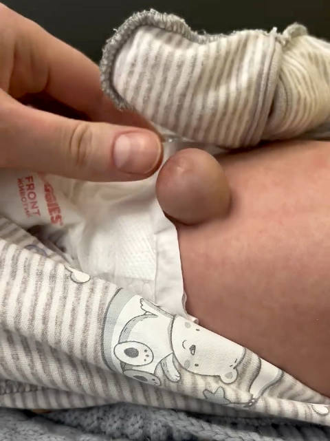 医学科普：婴儿脐疝