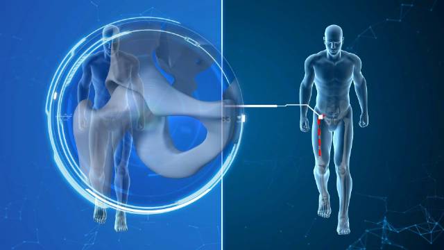 预告｜骨骼之间，也有蝴蝶效应