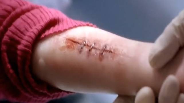 小女孩天生没有痛觉，手臂受伤自己用订书钉钉