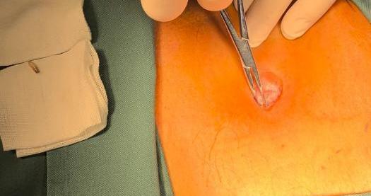 吓坏家人！七旬大爷被发现肚脐里有活蛆蠕动！专家：皮肤皱褶处易成为寄生虫“乐园”