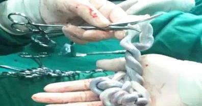 宝宝没出生，脐带打个“结”，专家：“生命线”可能秒变“夺命索”！