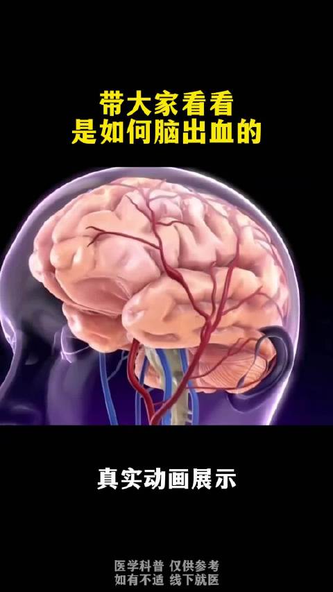 音乐人李偲菘突发脑出血，医生提醒发病6小时为黄金抢救期