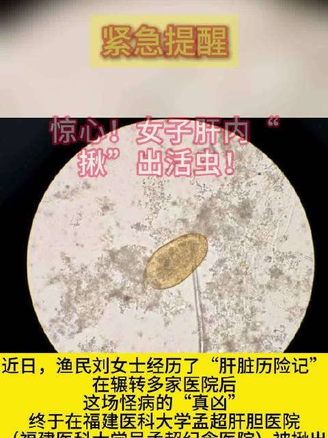 肝片吸虫寄生胆道可致胆管癌，污染水源食物为主要感染途径