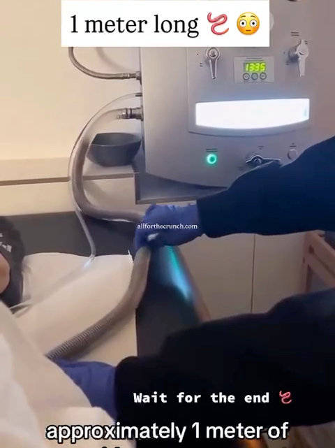 患者肠道排出一米长黏液被误认寄生虫