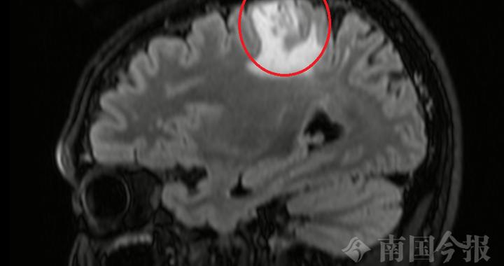 不要吃！不要吃！广西男子脑中揪出5厘米长虫！医生紧急提醒