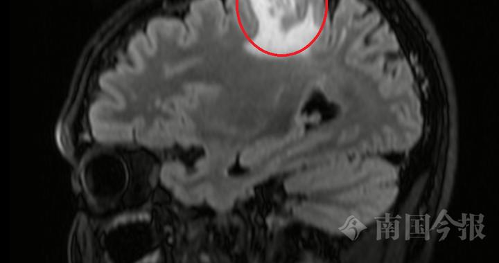 5厘米长寄生虫在男子脑内“安家”，柳州医生提醒：这些习惯要改！