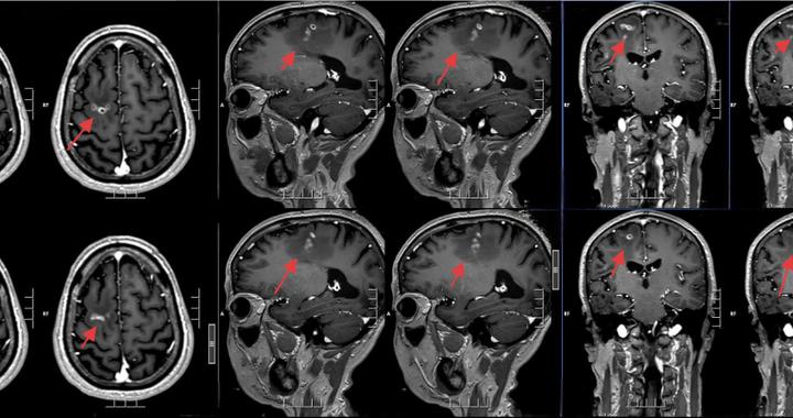 长达21年！广东男子脑内“住”了寄生虫……10厘米长！医生：千万不要这样做