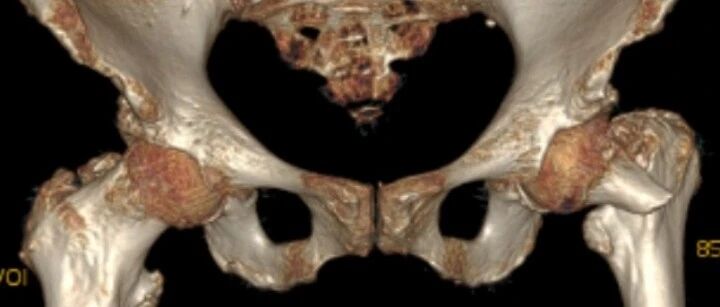 为了“走路不瘸”！郎平自曝接受这个手术，杭州97岁老人也做了