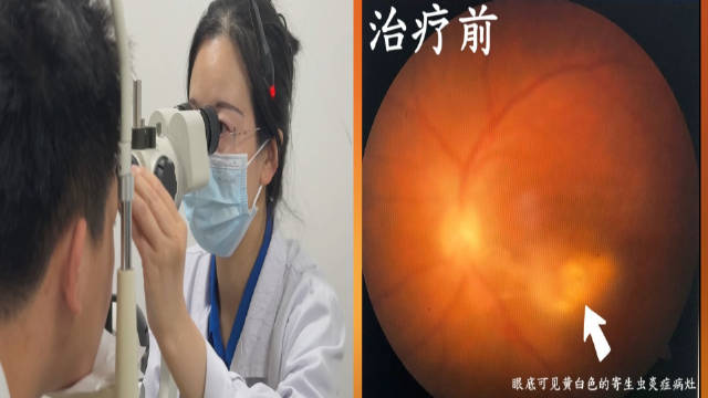 男子眼前出现黑影，竟是“撸猫”致寄生虫感染，视网膜水肿险失明