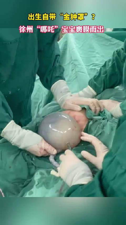 哪吒之徐州“分吒”，和平妇产医院接产“带壳宝宝”，神奇！