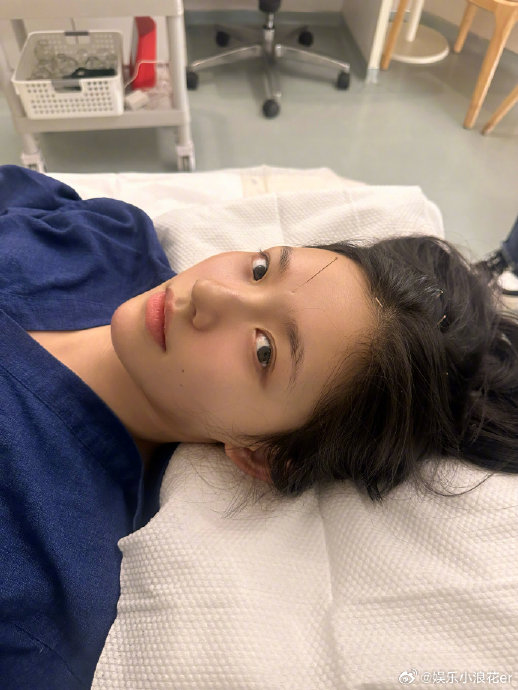 林允星光大赏后台针灸紧张喊不要行针