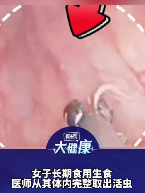 女子家住海边长期食用生食，出现反复腹痛、食欲不振等症状，医师从其体内完整取出活虫
