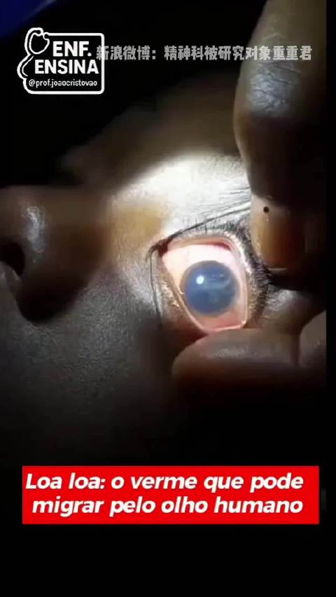 眼球内的寄生虫，通过皮下就能感染，也是生活环境很差才导致