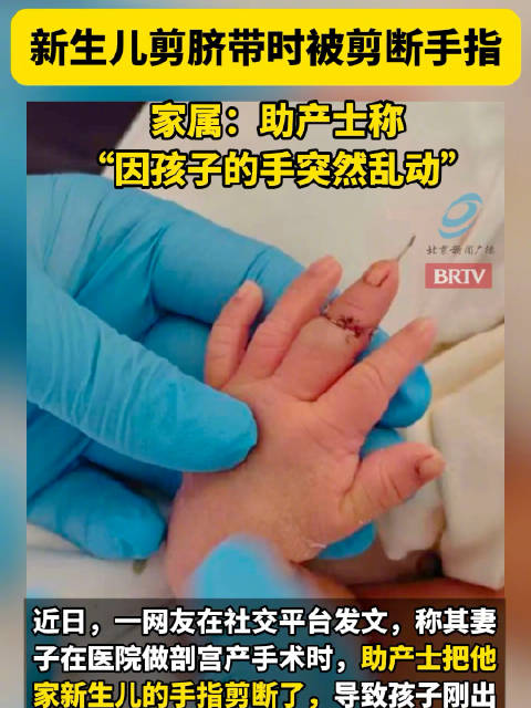 新生儿剪脐带时被剪断手指