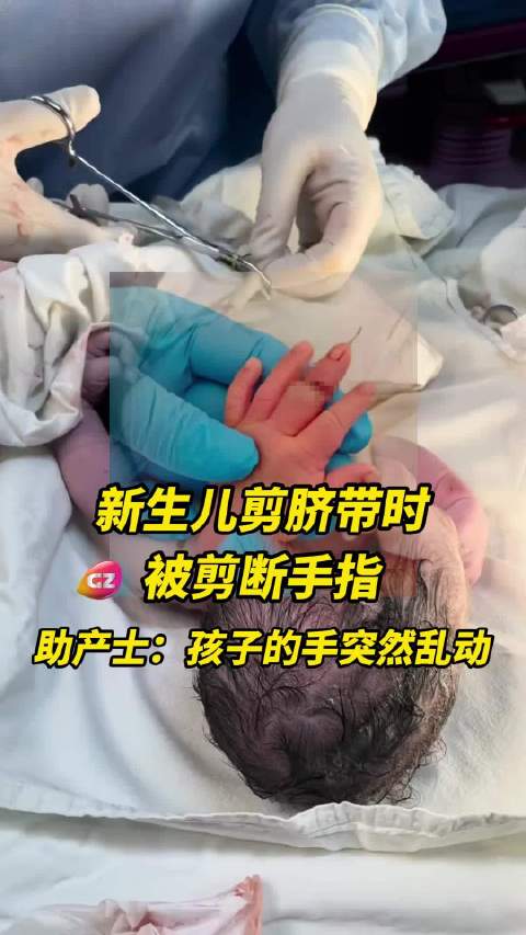 心疼！新生儿剪脐带时被剪断手指，事后助产士称，因为当时孩子的手突然乱动