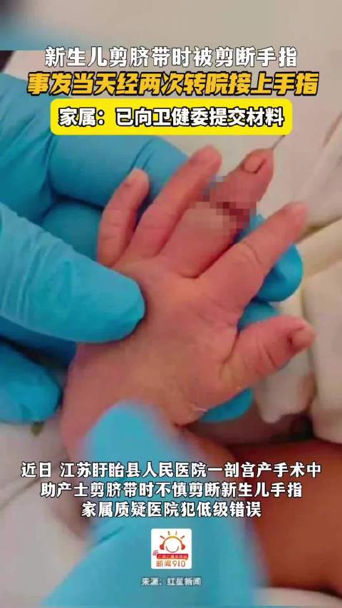 新生儿剪脐带被误剪断手指，当天转院两次成功接回