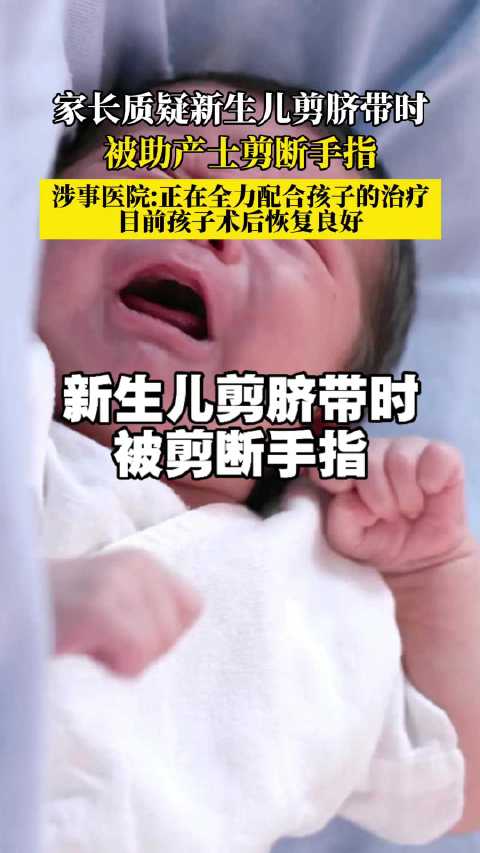 新生儿剪脐带时被助产士剪断手指