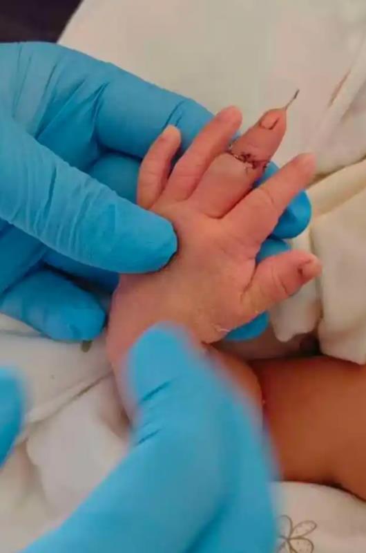 助产士剪断新生儿手指，低级失误是如何发生的