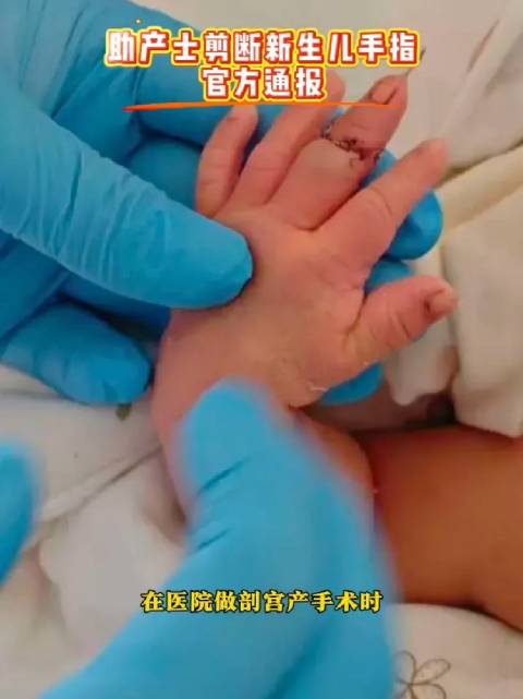 官方通报新生儿被剪断手指 好一个一个不小心