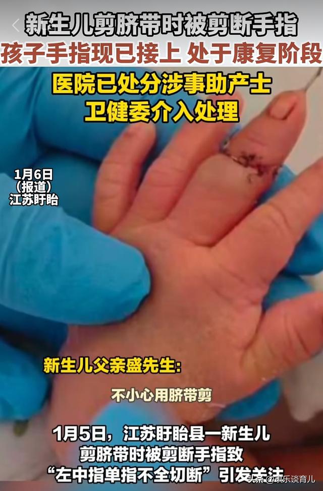 新生儿剪脐带剪断手指