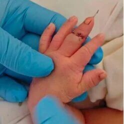 新生儿剪脐带时被剪断手指，官方通报来了