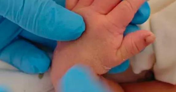 新生儿剪脐带时被剪断手指！家属：助产士称“因孩子的手突然乱动”，已申请医疗事故鉴定