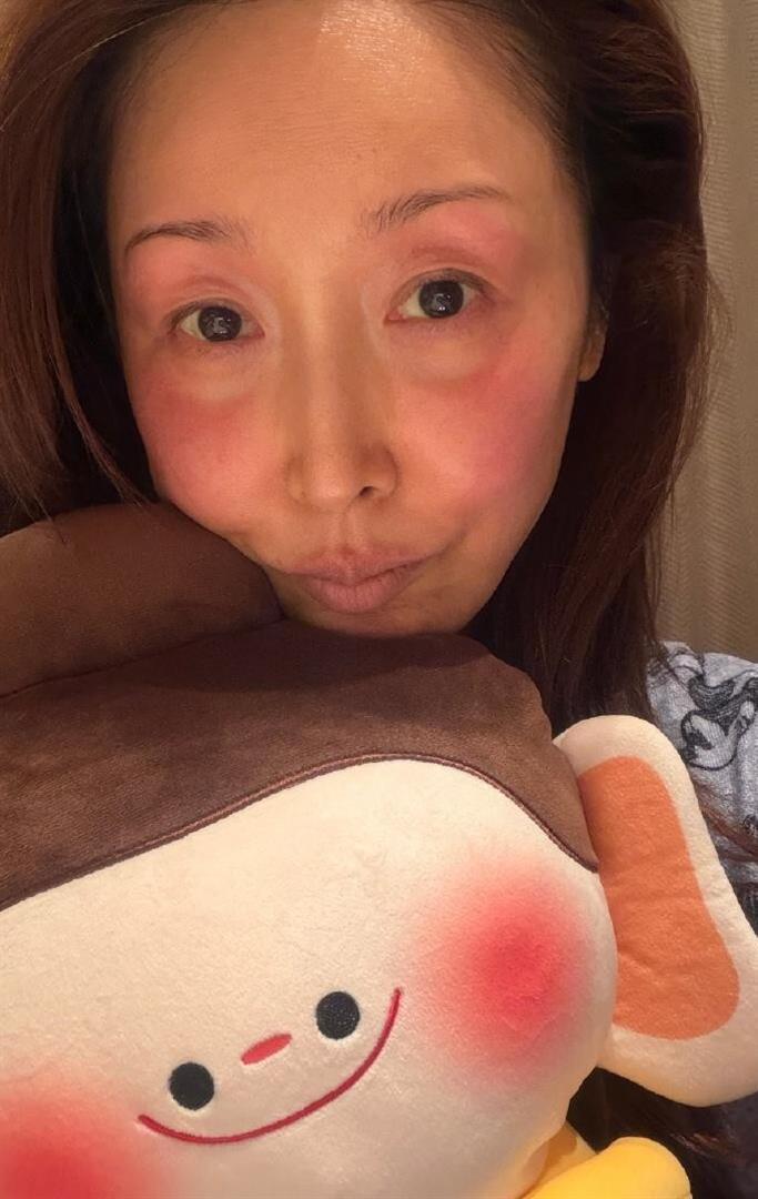 孙悦山西录春晚脸被冻伤，满脸红肿眼泡巨大，网友炸锅官方忙回应