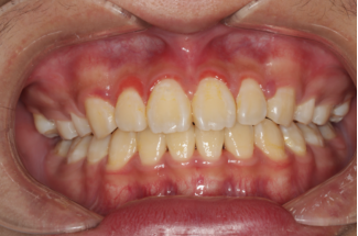 明星“牙龈肿如开特效”!口腔专家提醒:普通炎症与“脓肿危机”要分清