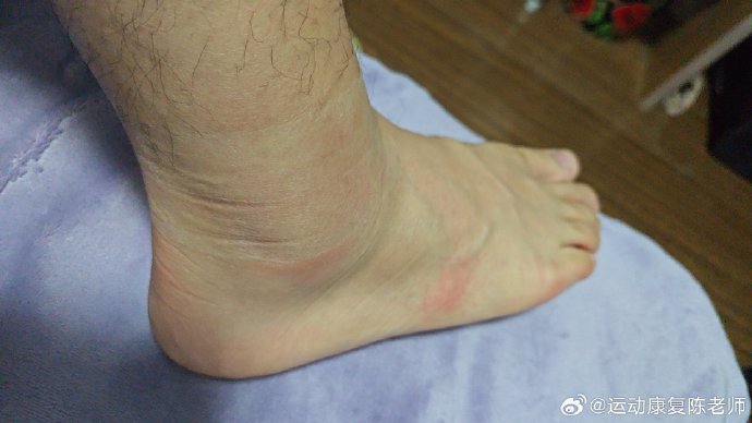 广东男篮后卫徐杰的具体伤情诊断和预计恢复时间是多久？