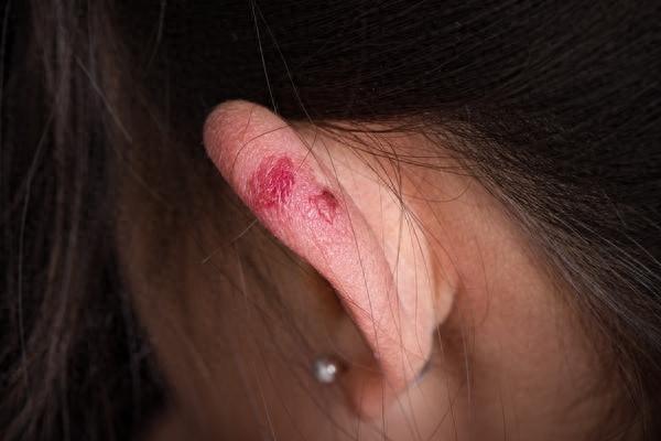 被冻伤的耳朵 视觉中国供图