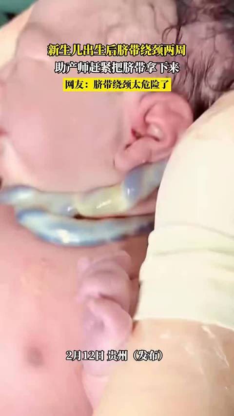 新生儿出生后脐带绕颈两周，助产师赶紧把脐带拿下来！
