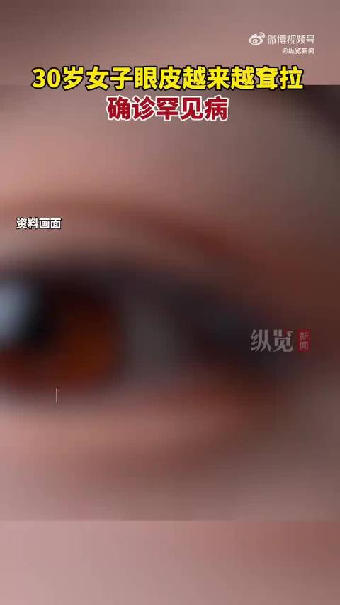 30岁女子眼皮耷拉确诊罕见病