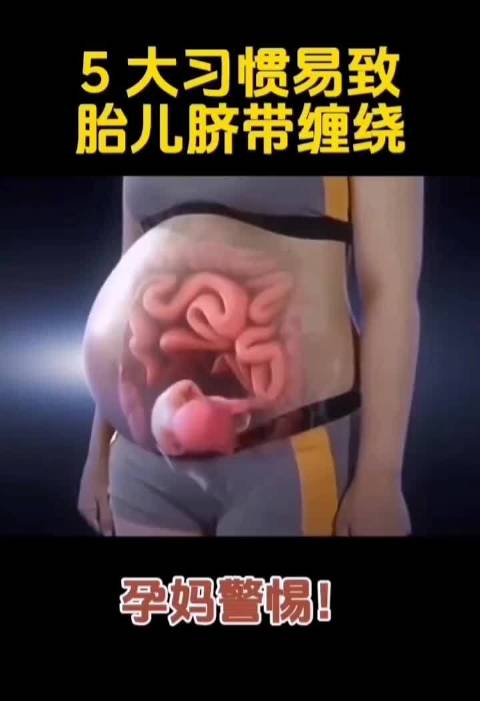 胎儿脐带扭转30圈风险高，孕妈需警惕胎动异常