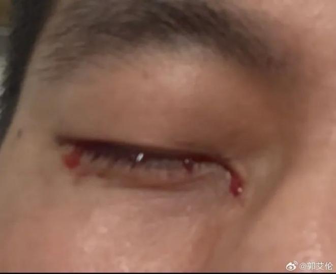 郭艾伦突发意外:被手指扎进眼珠,缝了40多针