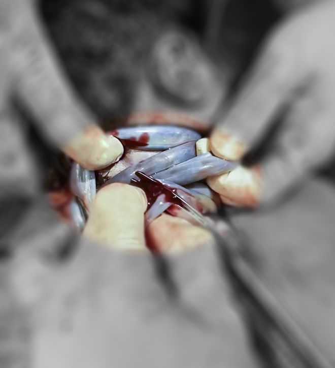 胎儿突然“文静”，竟是被脐带“勒脖”5圈 医生紧急剖宫产抢出宝宝