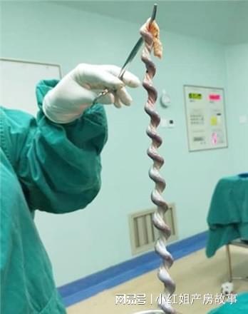 脐带扭转不可怕，每个胎儿都会遇到，但为什么不能超过11圈