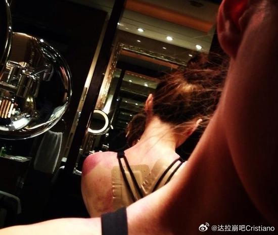 阿娇钟欣潼为了拍打戏受过哪些严重的伤？