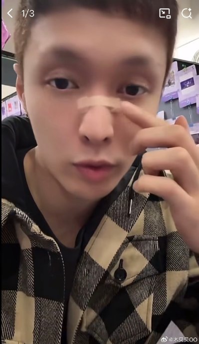 张艺兴‘鼻中隔偏曲手术’的具体情况是怎样的，对他影响有多大？