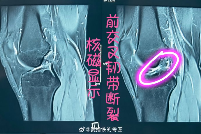 郭艾伦左膝前交叉韧带断裂手术的具体情况和主刀专家是谁？